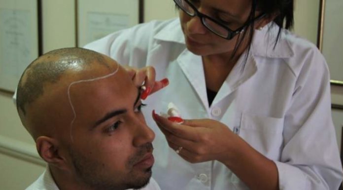 Turquía se convierte en potencia turística gracias a las operaciones contra la calvicie a “bajo costo”